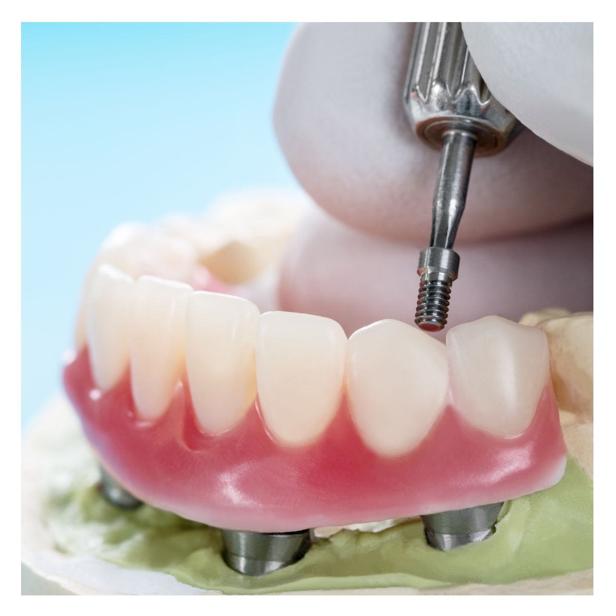 implant-supported dentures